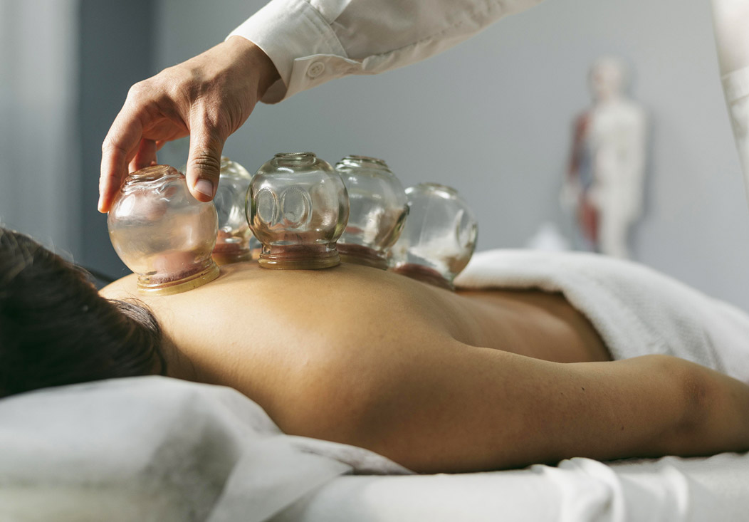 acupuncture-cupping