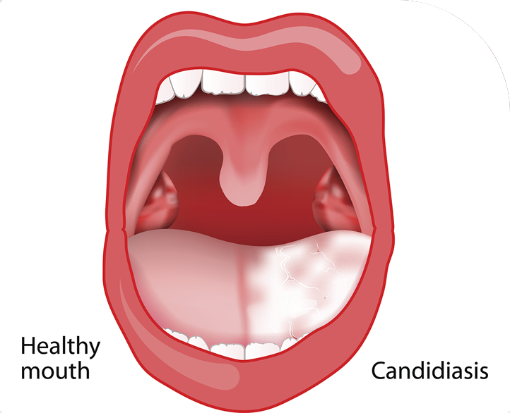 candida-causes-signs-symptoms