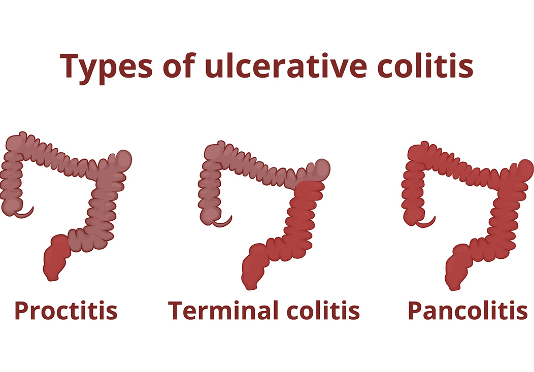 ulcerative-colitis-diagnosis