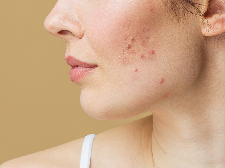 Acne Over 30? It’s More Than Just Hormones