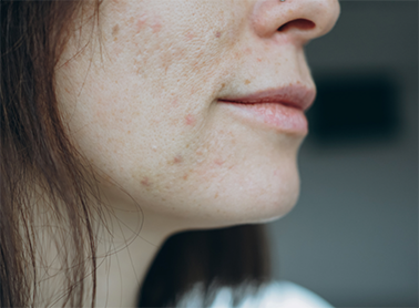 What Are the 3 Common Causes of Acne Breakouts ...