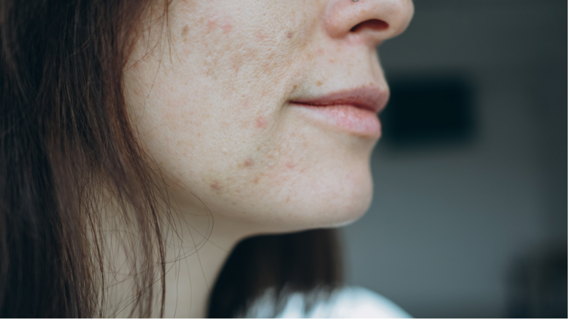 Acne Over 30? It’s More Than Just Hormones    