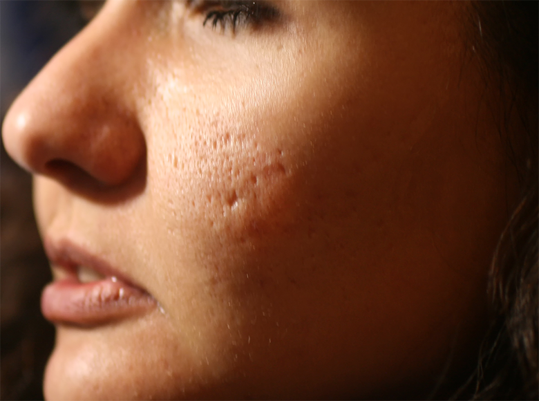 Microneedling Facials –Promising Results For Acne Scar Patients