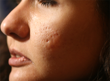 Microneedling Facials –Promising Results For ...